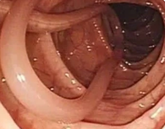 Endoscopie parasites intestinaux